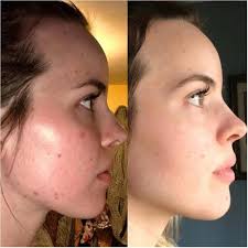 The Ordinary Azelaic Acid Suspension 10% | a-z cosmetics